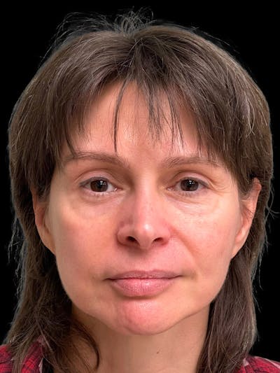 Blepharoplasty Before & After Gallery - Patient 241354 - Image 2