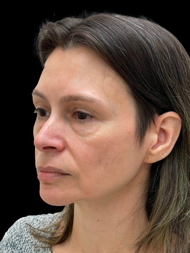 Blepharoplasty Before & After Gallery - Patient 241354 - Image 3