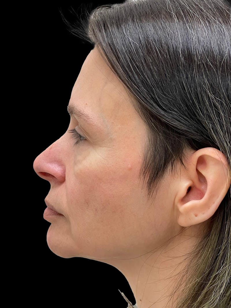 Blepharoplasty Before & After Gallery - Patient 241354 - Image 5