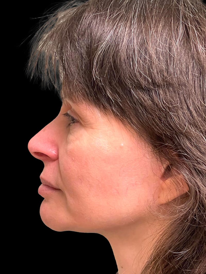 Blepharoplasty Before & After Gallery - Patient 241354 - Image 6