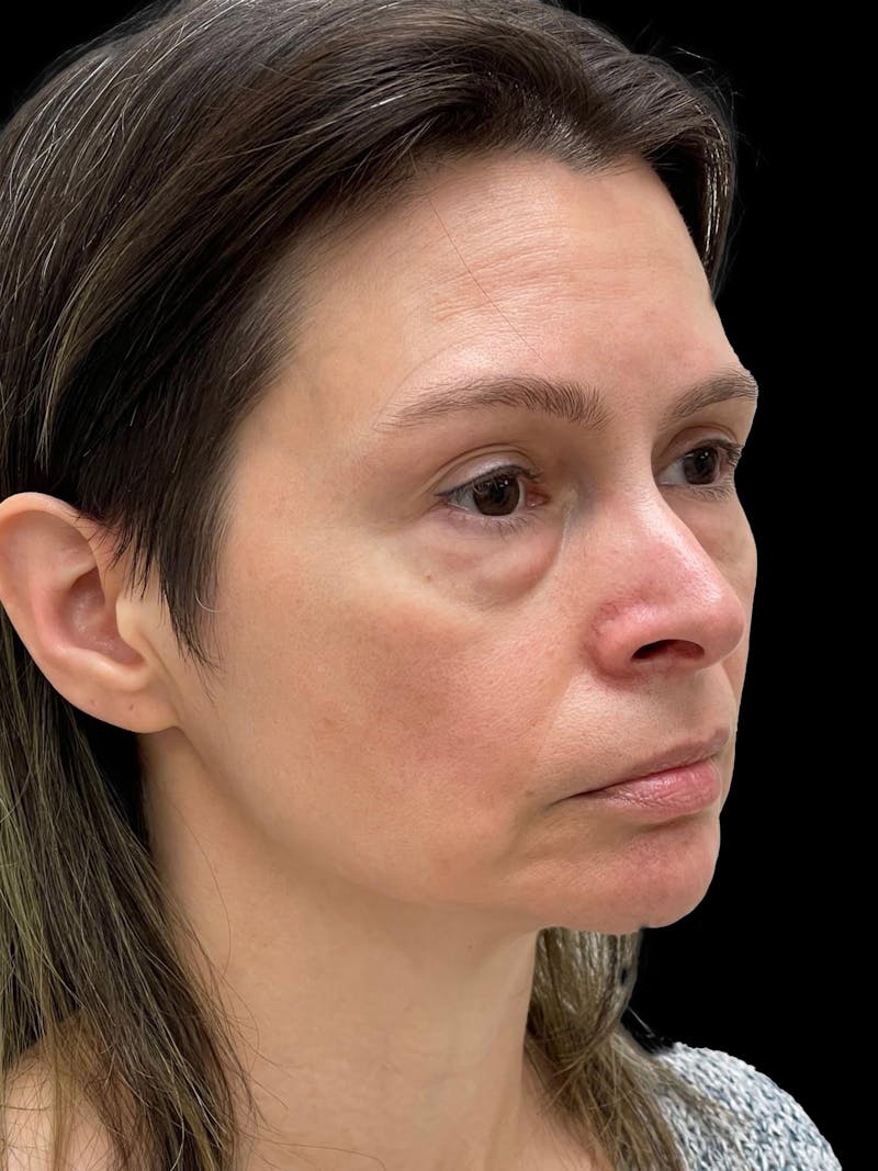 Blepharoplasty Before & After Gallery - Patient 241354 - Image 7