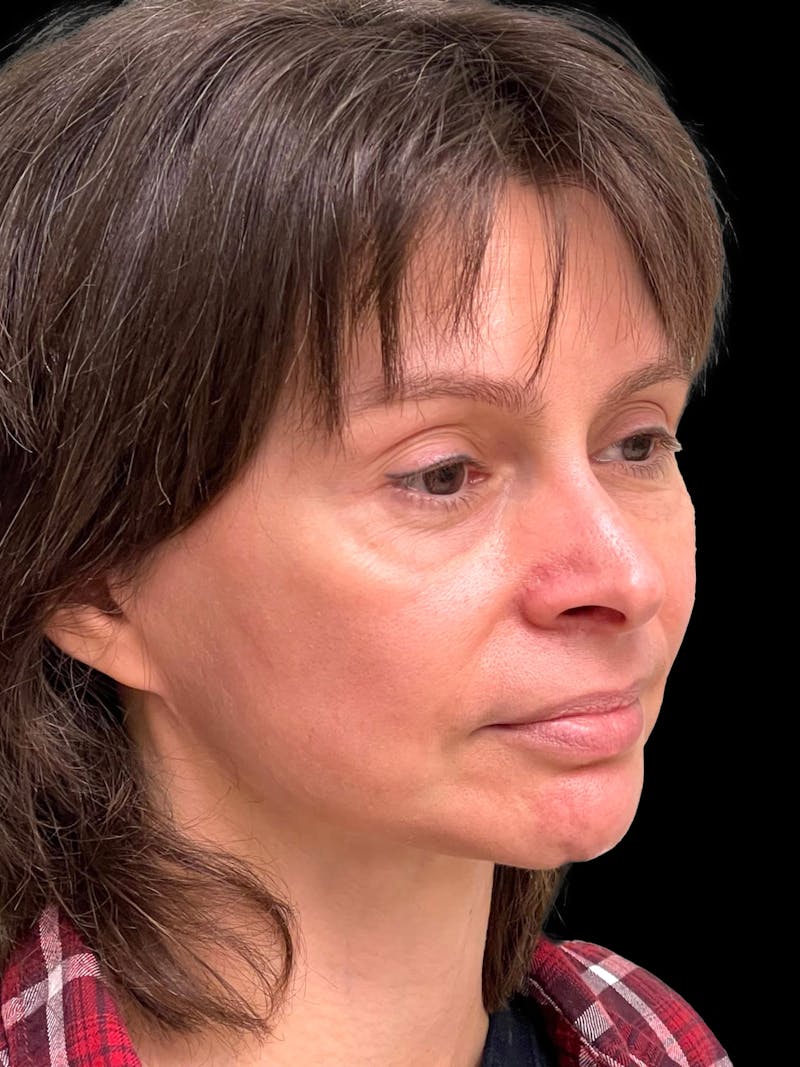 Blepharoplasty Before & After Gallery - Patient 241354 - Image 8