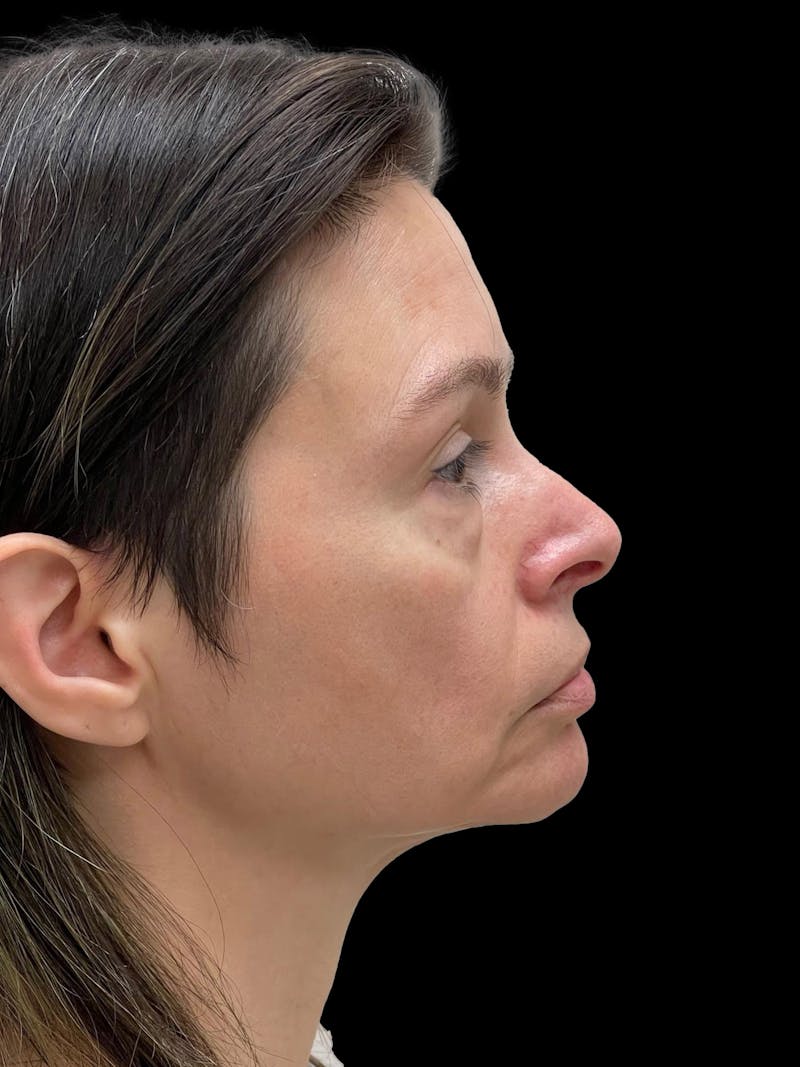 Blepharoplasty Before & After Gallery - Patient 241354 - Image 9