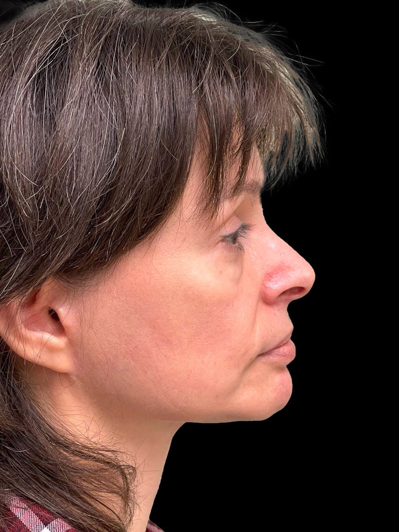 Blepharoplasty Before & After Gallery - Patient 241354 - Image 10
