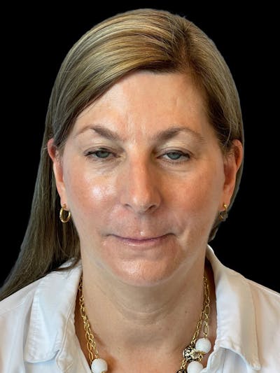 Blepharoplasty Before & After Gallery - Patient 426815 - Image 1