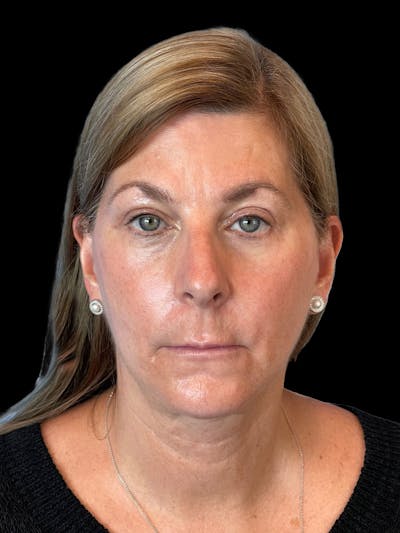 Blepharoplasty Before & After Gallery - Patient 426815 - Image 2