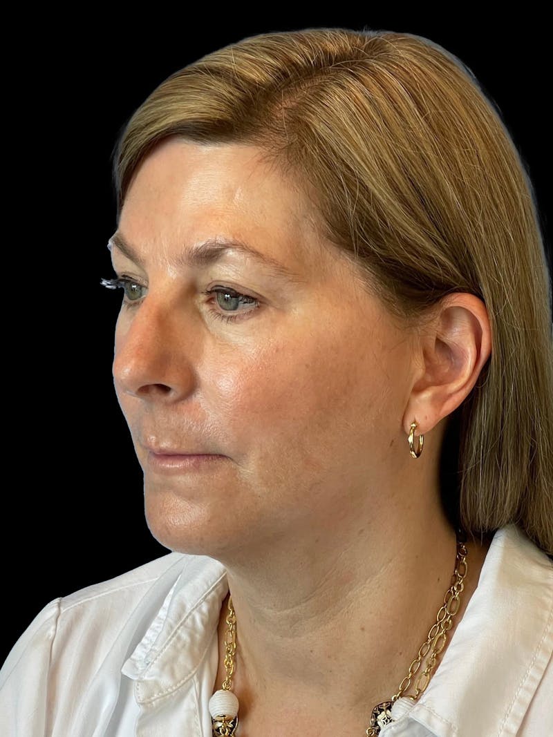 Necklift Before & After Gallery - Patient 411895 - Image 3