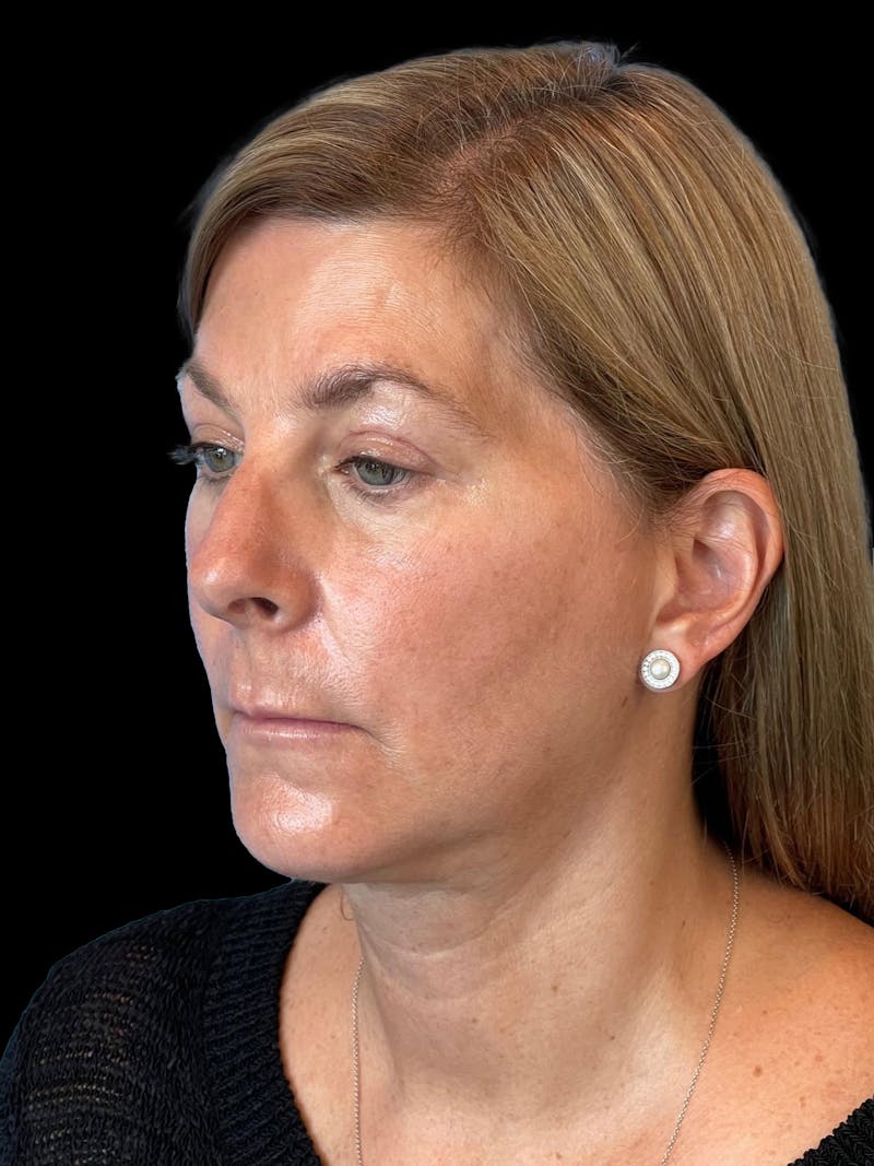 Necklift Before & After Gallery - Patient 411895 - Image 4