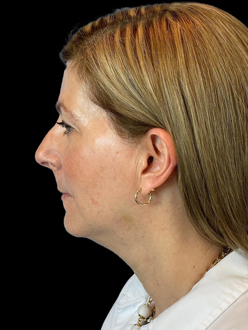 Necklift Before & After Gallery - Patient 411895 - Image 5