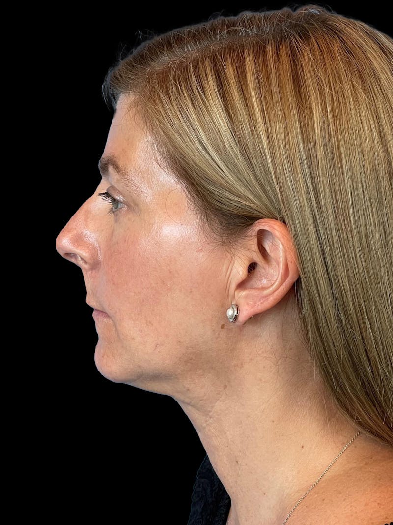 Necklift Before & After Gallery - Patient 411895 - Image 6