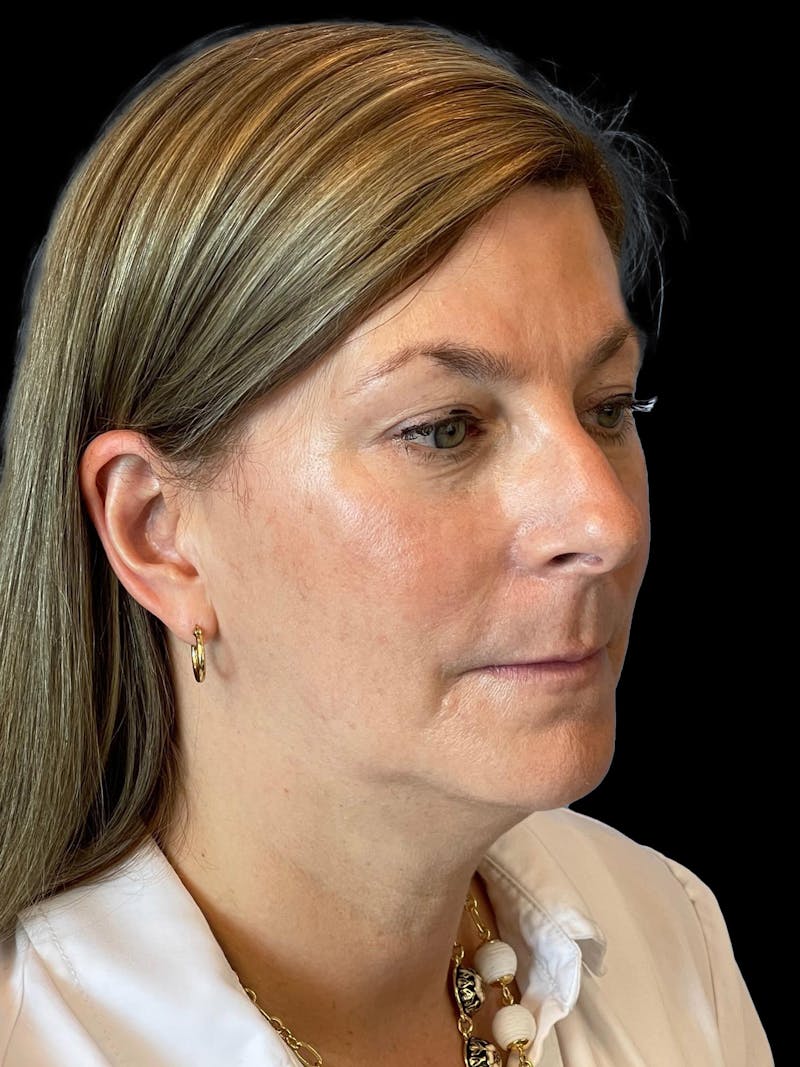 Necklift Before & After Gallery - Patient 411895 - Image 7