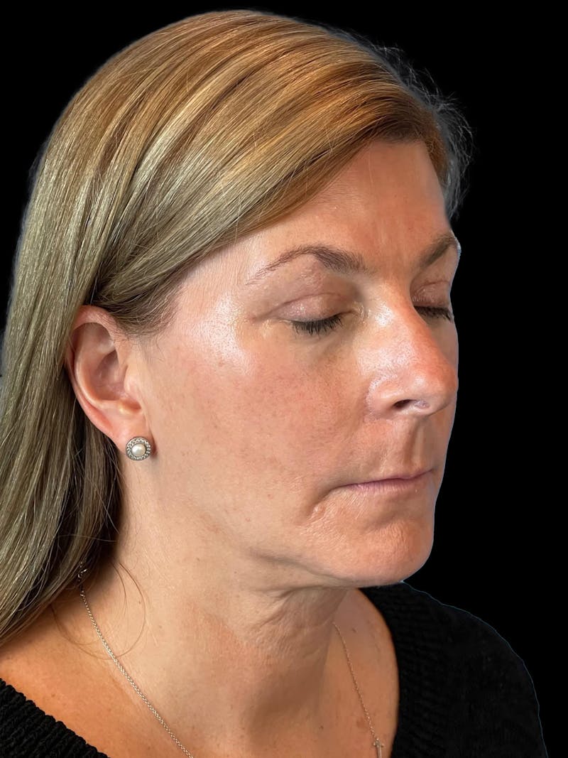 Necklift Before & After Gallery - Patient 411895 - Image 8