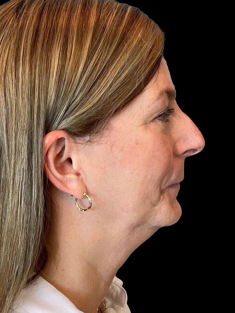 Necklift Before & After Gallery - Patient 411895 - Image 9