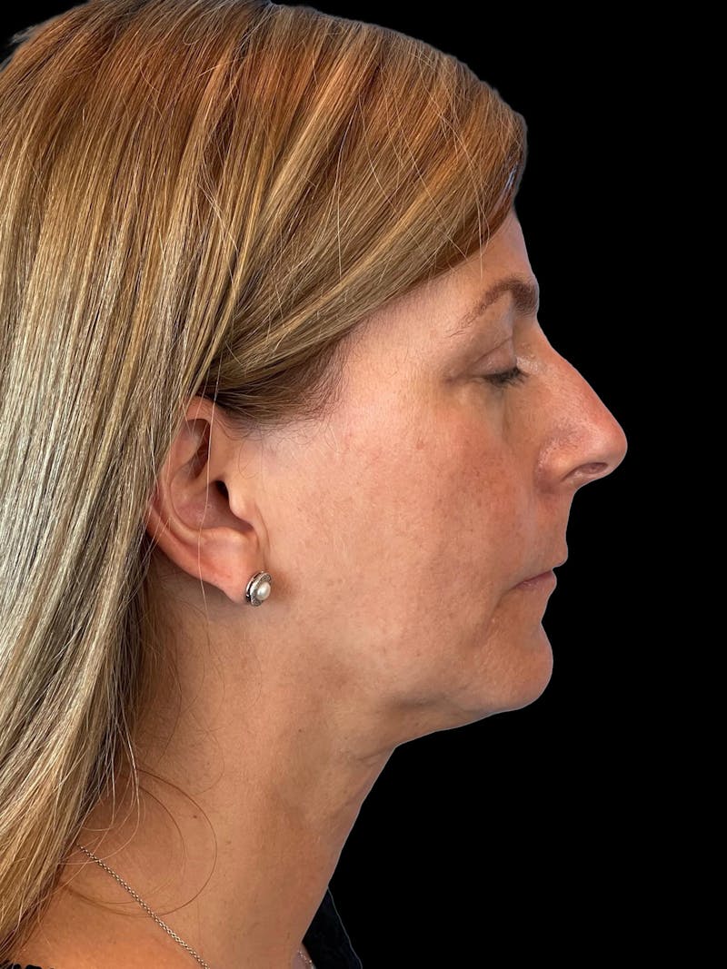 Necklift Before & After Gallery - Patient 411895 - Image 10