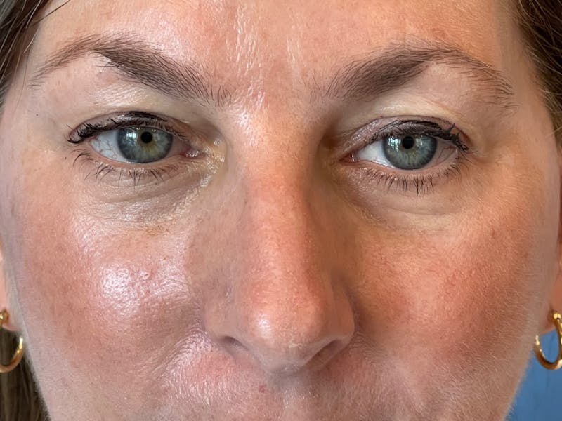 Necklift Before & After Gallery - Patient 411895 - Image 11