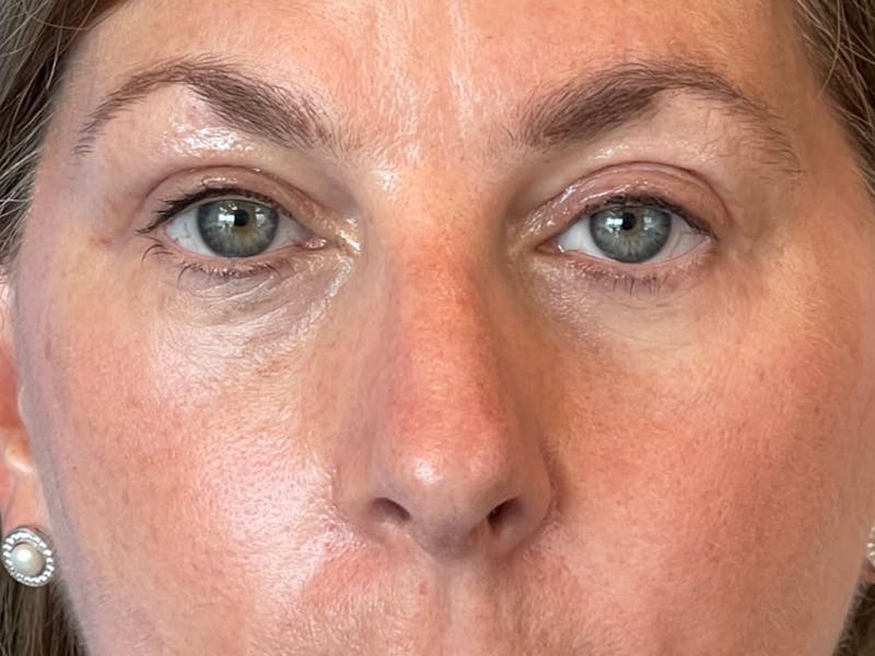 Necklift Before & After Gallery - Patient 411895 - Image 12