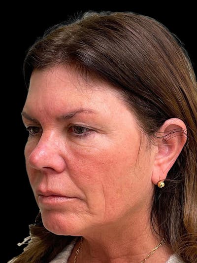 Blepharoplasty Before & After Gallery - Patient 286893 - Image 1