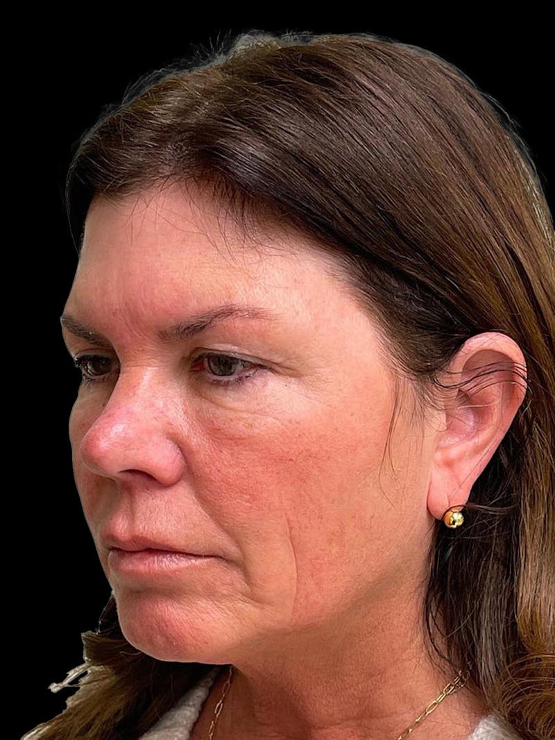 Blepharoplasty Before & After Gallery - Patient 286893 - Image 1