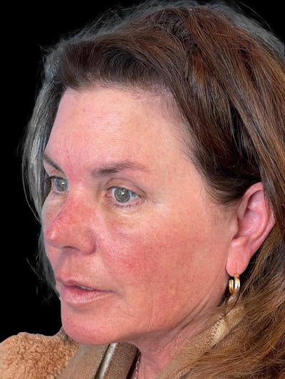 Blepharoplasty Before & After Gallery - Patient 286893 - Image 2