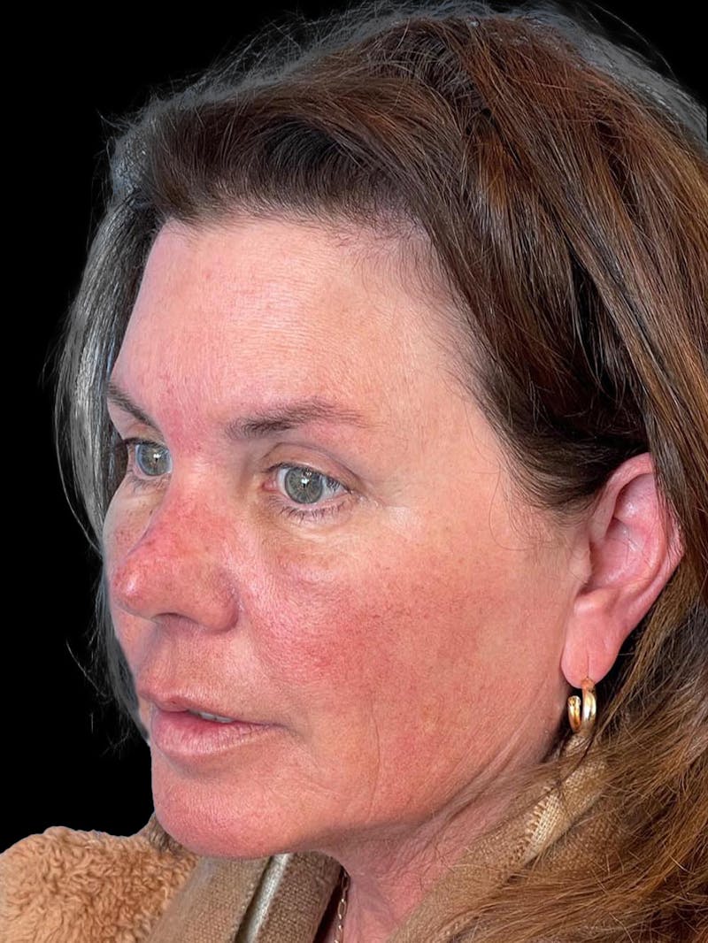 Blepharoplasty Before & After Gallery - Patient 286893 - Image 2