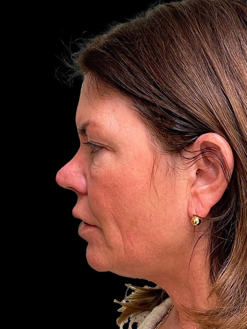 Blepharoplasty Before & After Gallery - Patient 286893 - Image 3