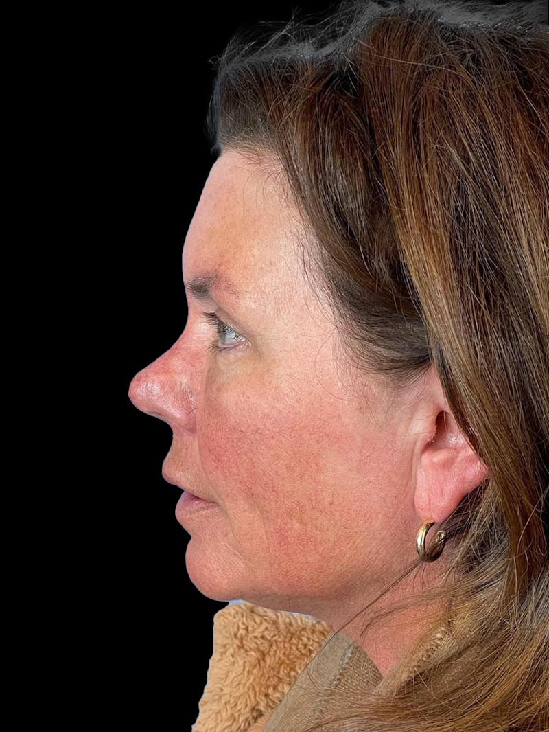 Blepharoplasty Before & After Gallery - Patient 286893 - Image 4