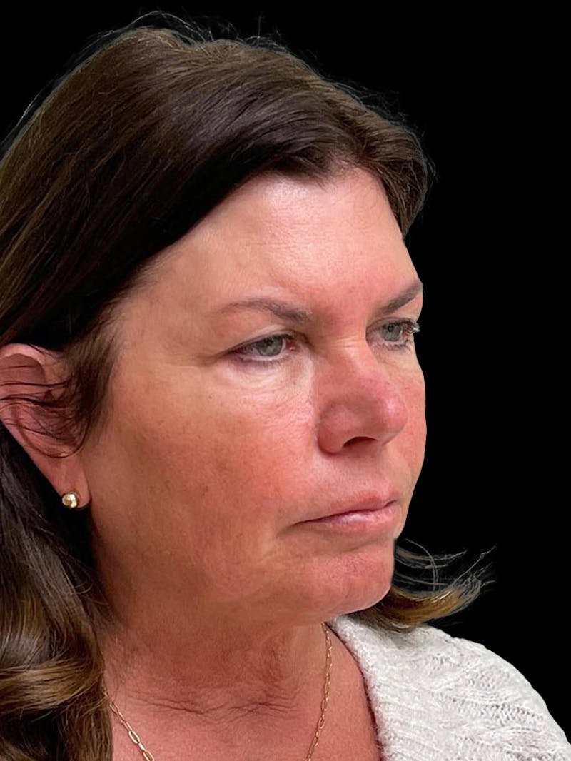 Blepharoplasty Before & After Gallery - Patient 286893 - Image 5