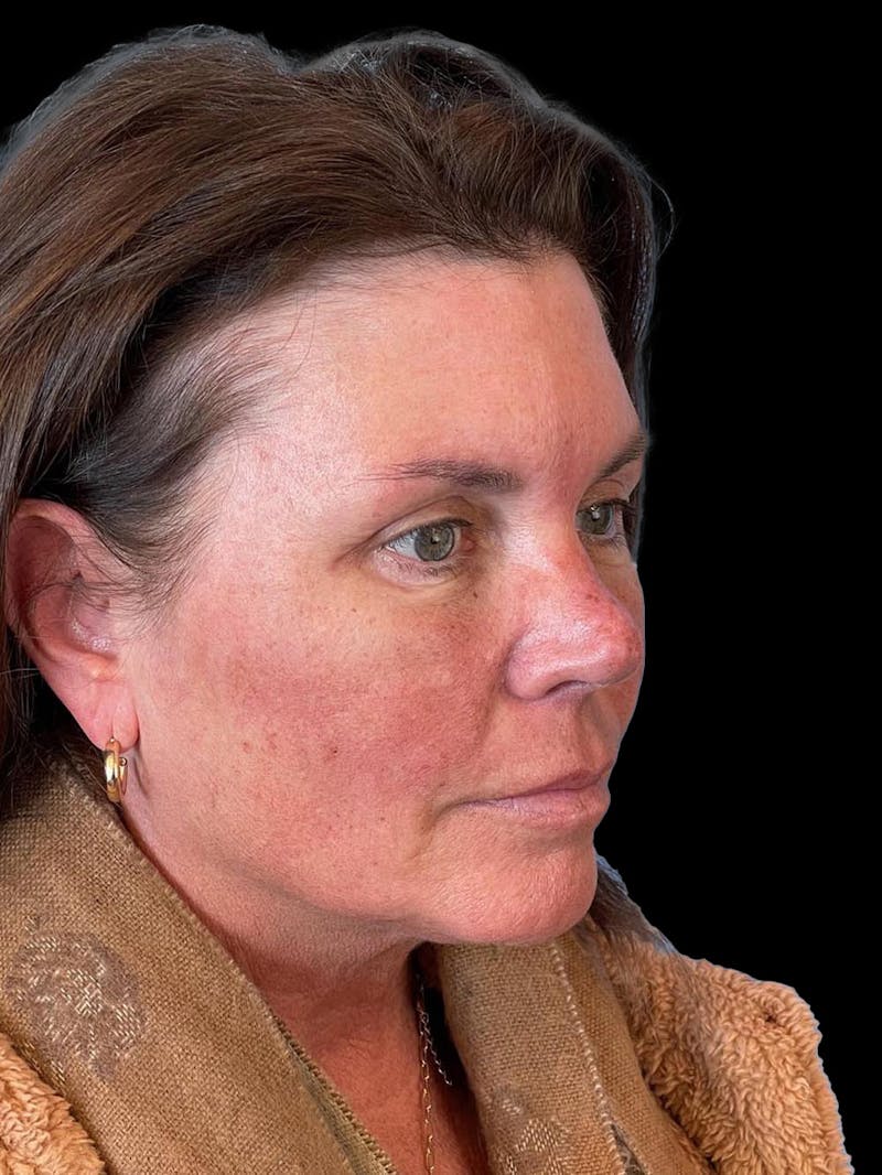 Blepharoplasty Before & After Gallery - Patient 286893 - Image 6