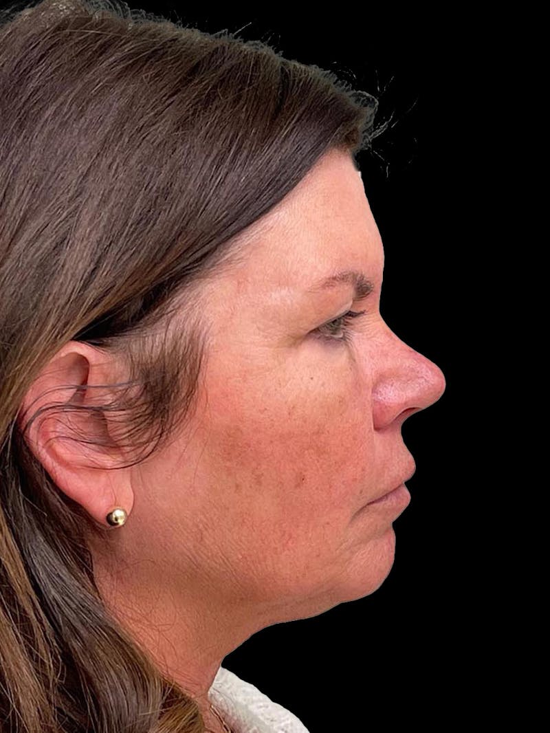 Blepharoplasty Before & After Gallery - Patient 286893 - Image 7