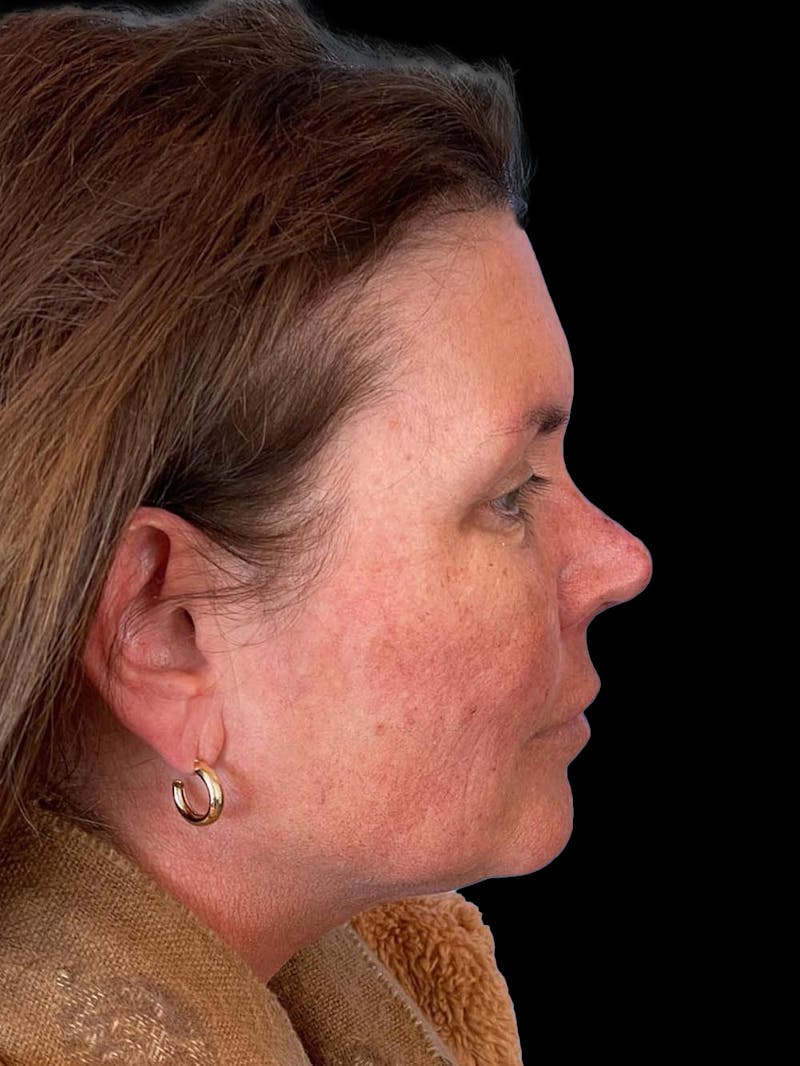 Blepharoplasty Before & After Gallery - Patient 286893 - Image 8