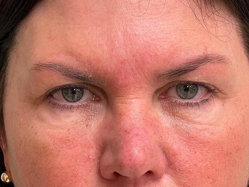 Blepharoplasty Before & After Gallery - Patient 286893 - Image 9