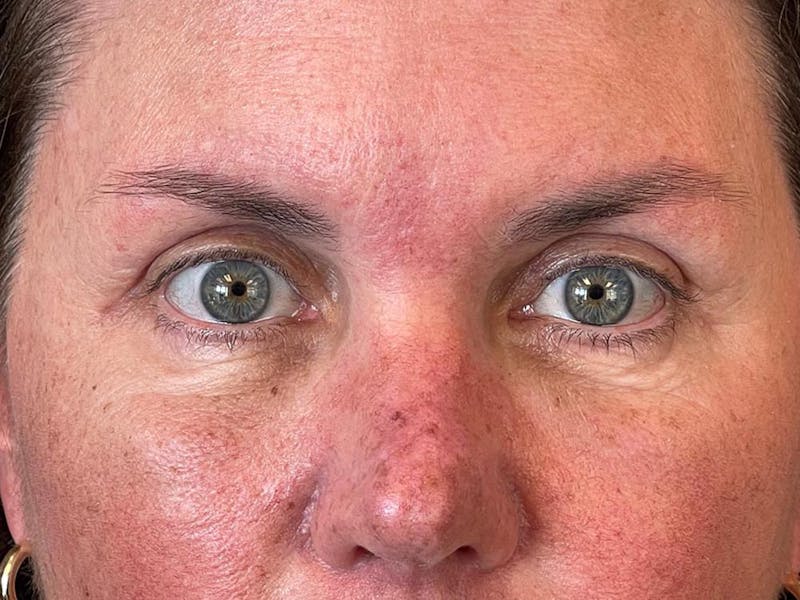 Blepharoplasty Before & After Gallery - Patient 286893 - Image 10
