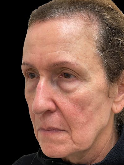 Blepharoplasty Before & After Gallery - Patient 261588 - Image 1