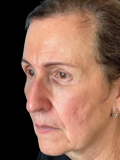 Blepharoplasty Before & After Gallery - Patient 261588 - Image 2
