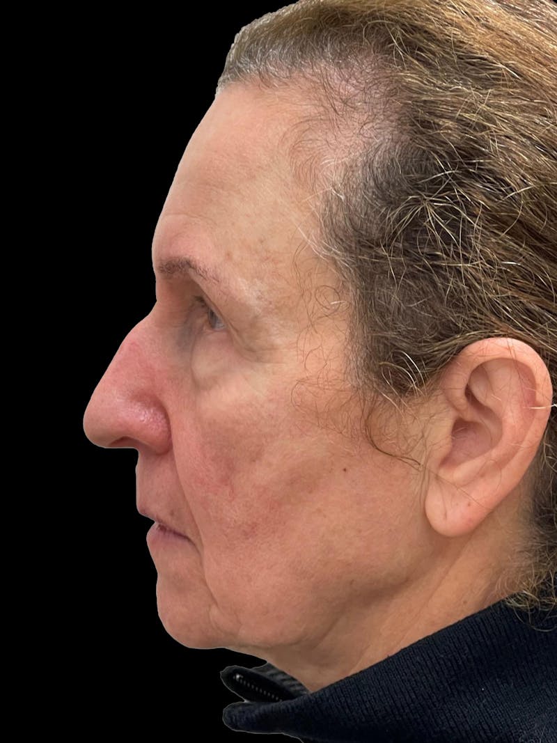 Blepharoplasty Before & After Gallery - Patient 261588 - Image 3