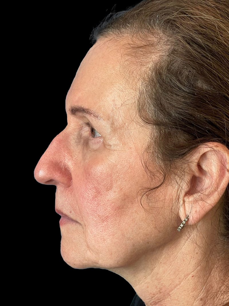 Blepharoplasty Before & After Gallery - Patient 261588 - Image 4