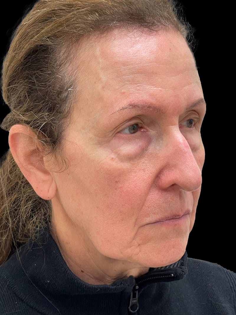 Blepharoplasty Before & After Gallery - Patient 261588 - Image 5