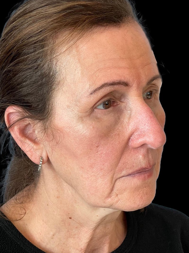 Blepharoplasty Before & After Gallery - Patient 261588 - Image 6