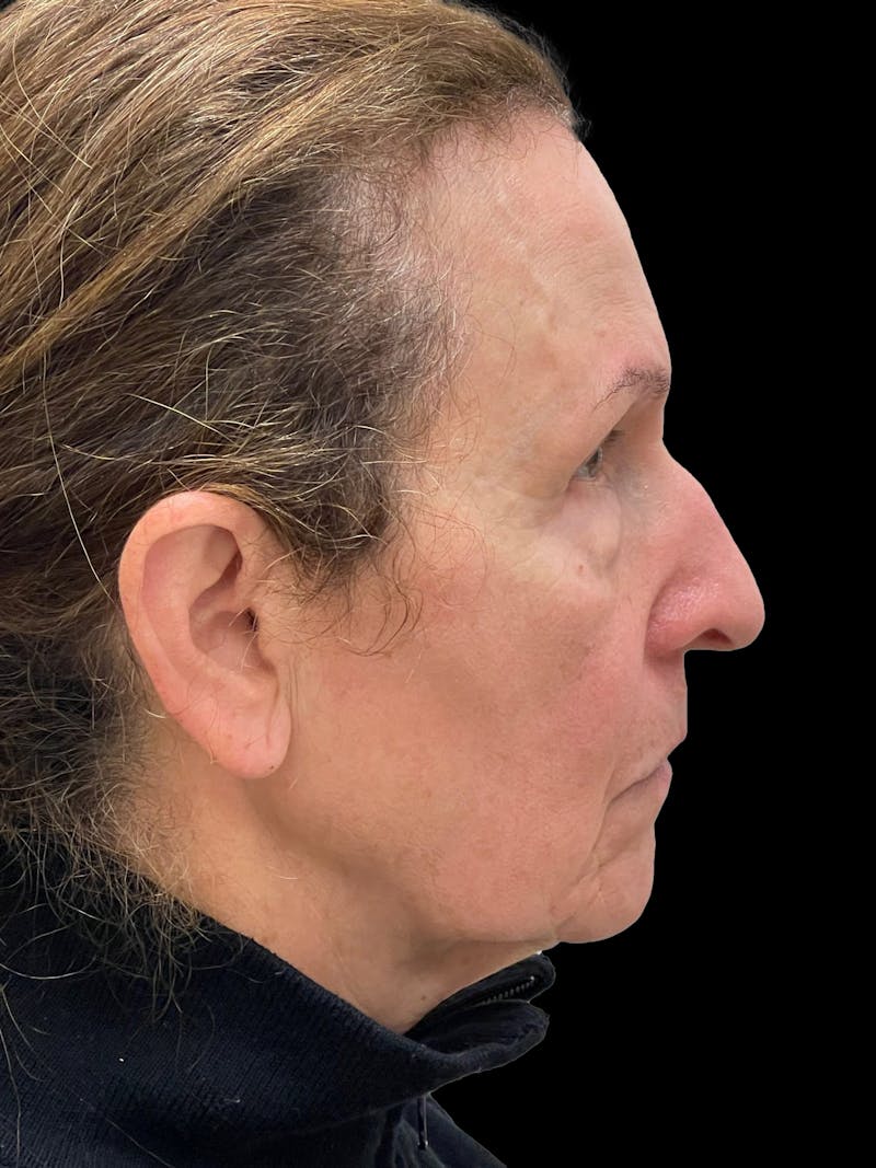 Blepharoplasty Before & After Gallery - Patient 261588 - Image 7