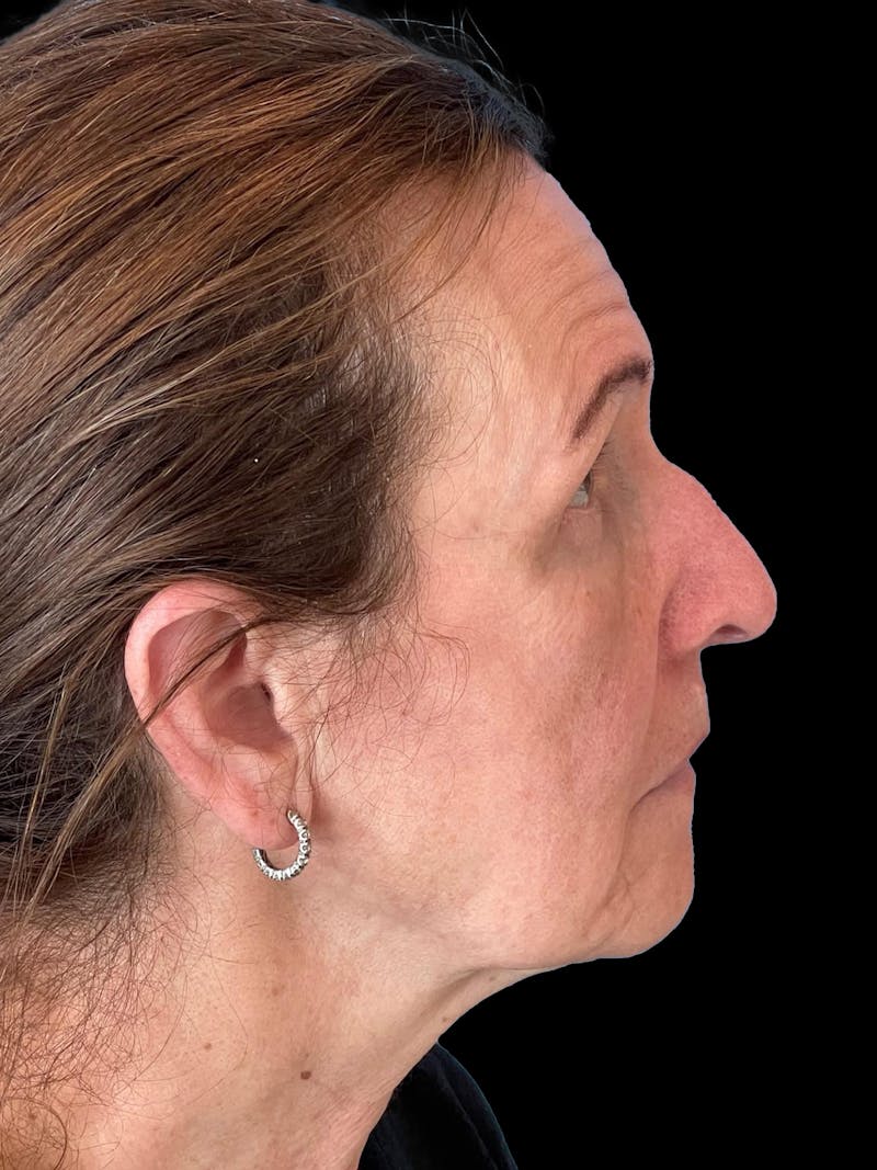 Blepharoplasty Before & After Gallery - Patient 261588 - Image 8