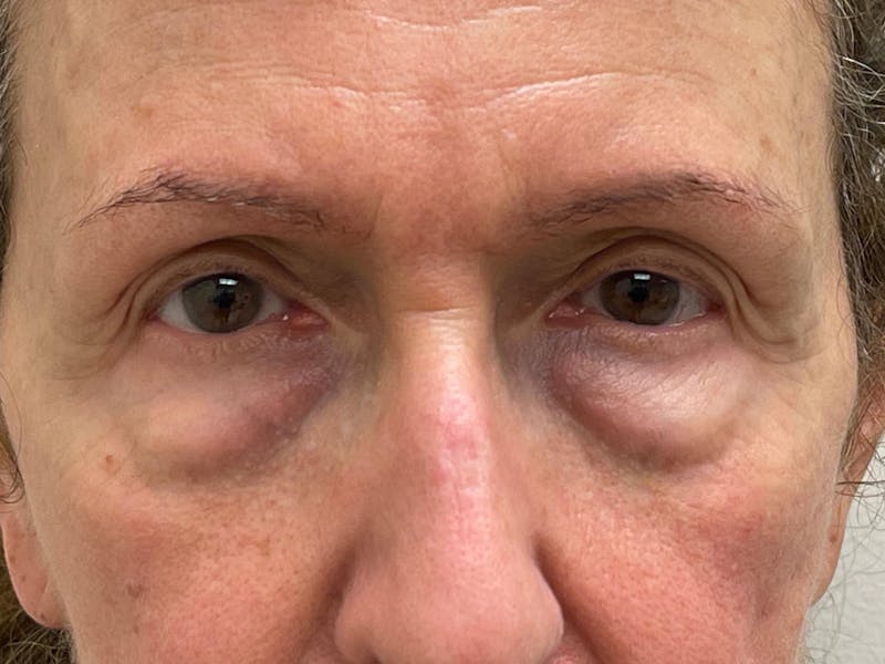 Blepharoplasty Before & After Gallery - Patient 261588 - Image 9