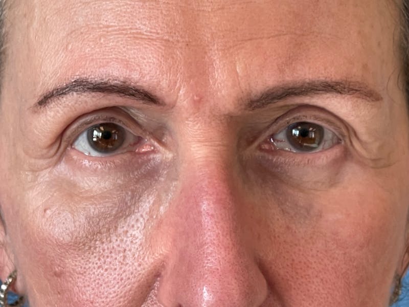 Blepharoplasty Before & After Gallery - Patient 261588 - Image 10