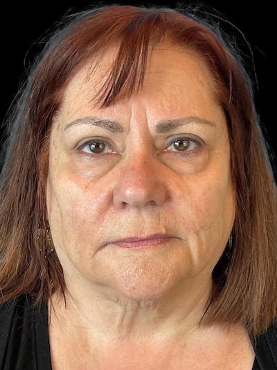 Blepharoplasty Before & After Gallery - Patient 121491 - Image 1