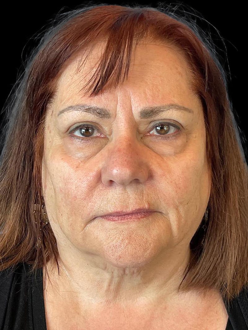 Blepharoplasty Before & After Gallery - Patient 121491 - Image 1