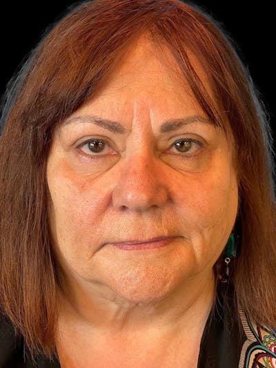 Blepharoplasty Before & After Gallery - Patient 121491 - Image 2