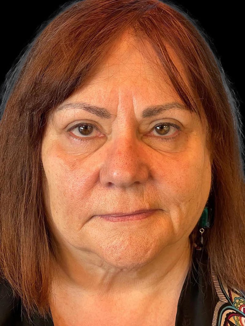 Blepharoplasty Before & After Gallery - Patient 121491 - Image 2
