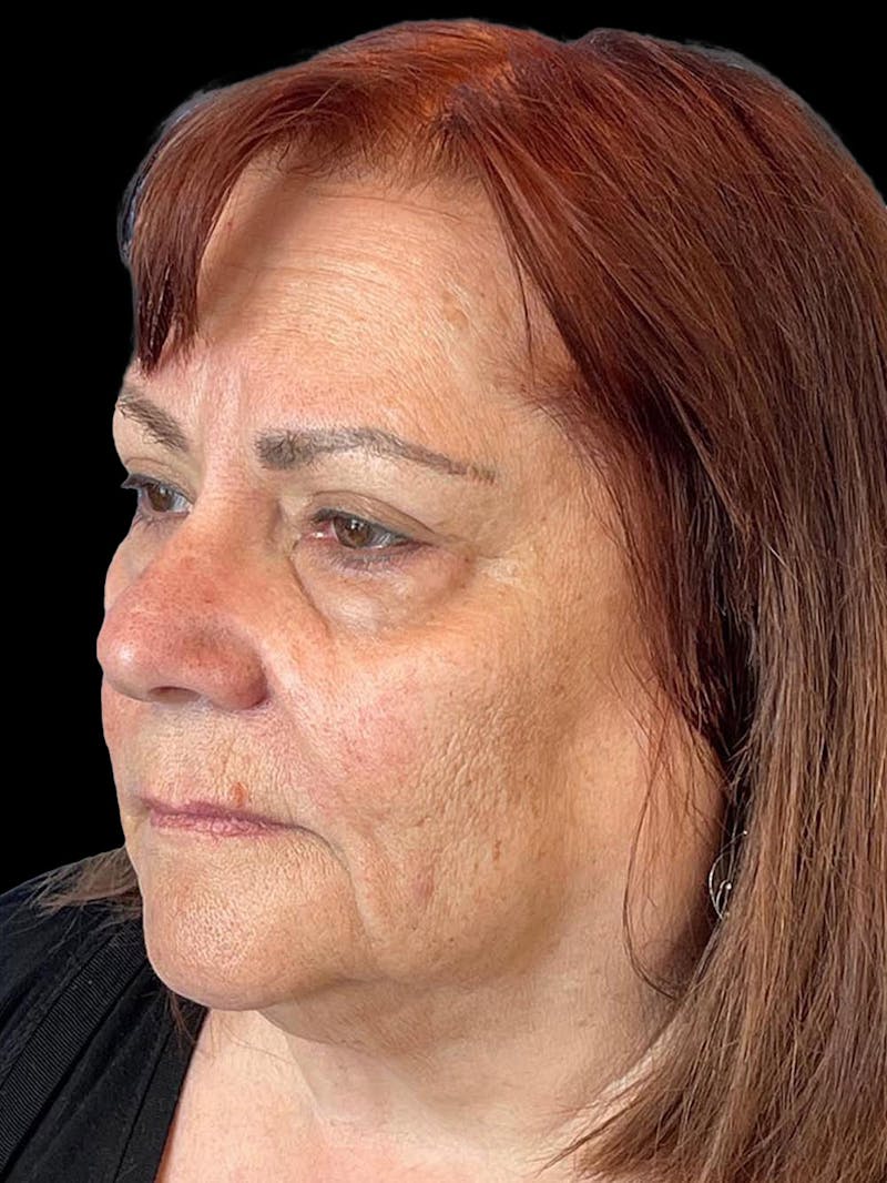 Blepharoplasty Before & After Gallery - Patient 121491 - Image 3