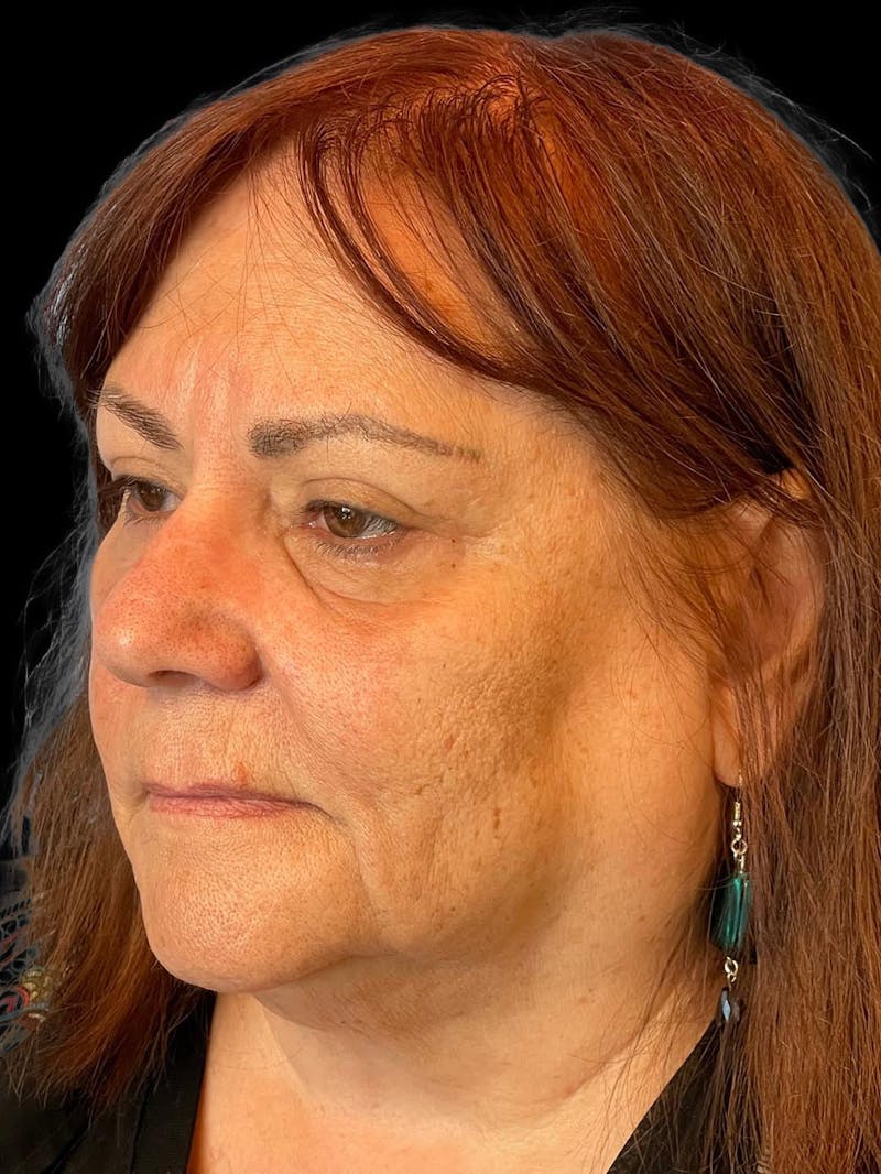Blepharoplasty Before & After Gallery - Patient 121491 - Image 4