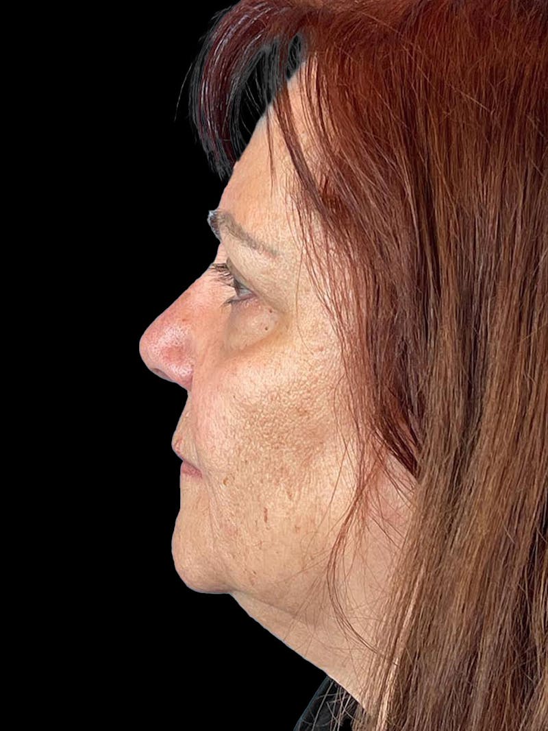 Blepharoplasty Before & After Gallery - Patient 121491 - Image 5