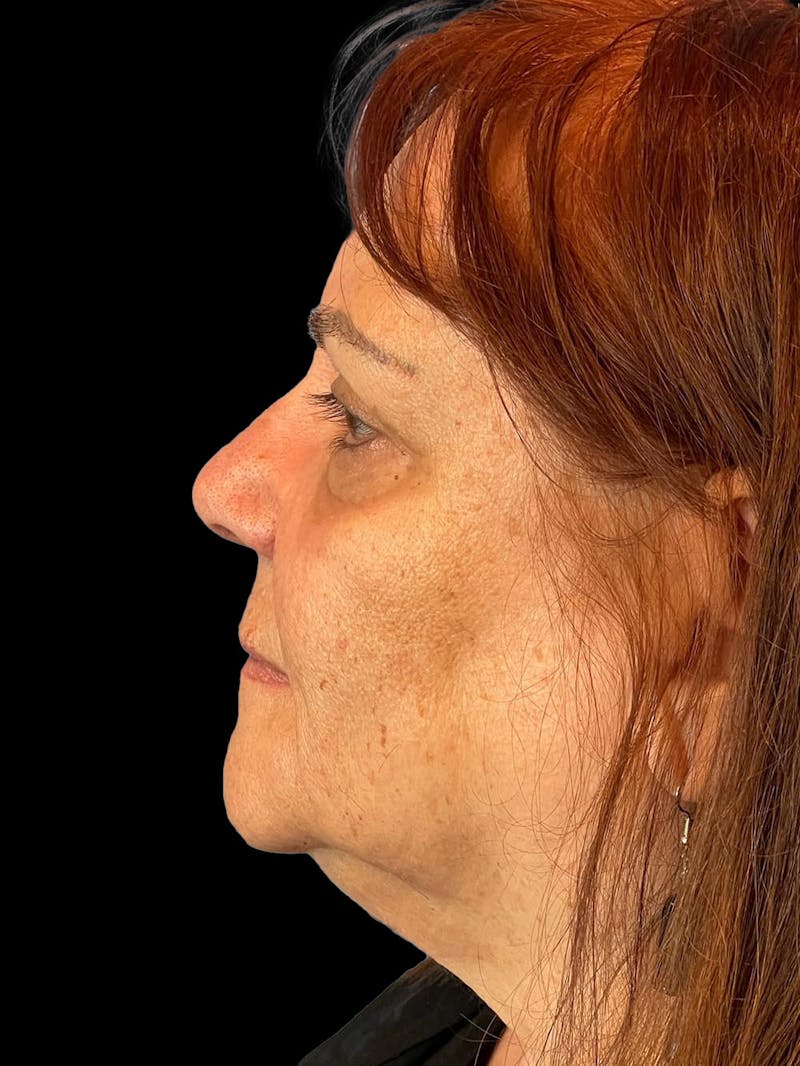 Blepharoplasty Before & After Gallery - Patient 121491 - Image 6